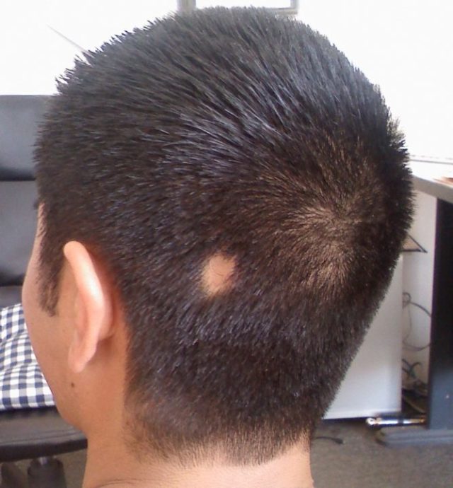 vypadenie-volos-u-muzhchin