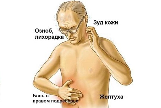 признаки рака поджелудочной железы