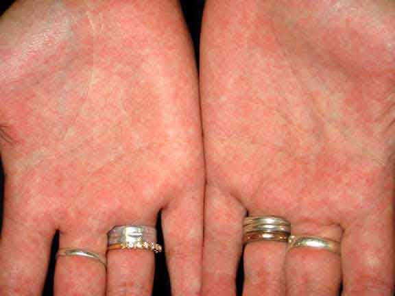 скарлатина у взрослого на руках