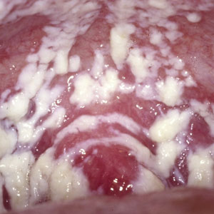 Дифлкан при молочнице