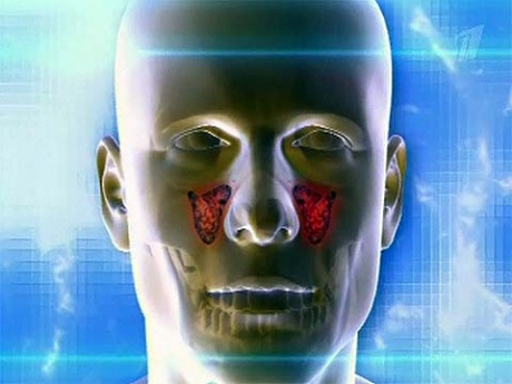 Острый гайморит