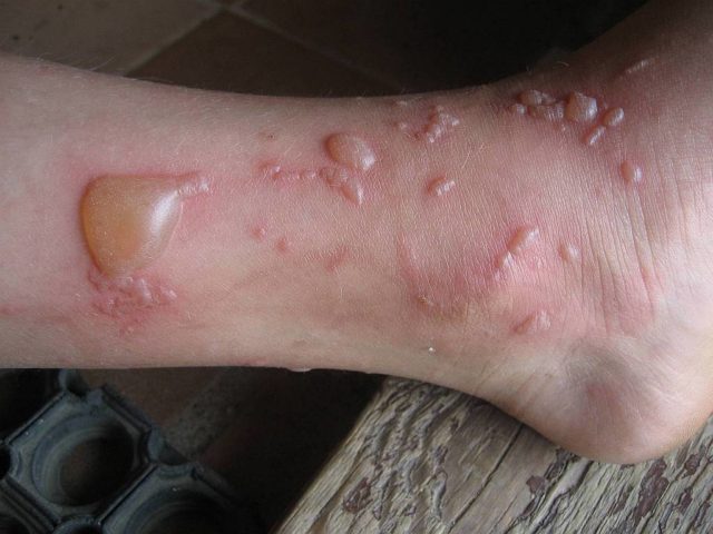 ожог на теле