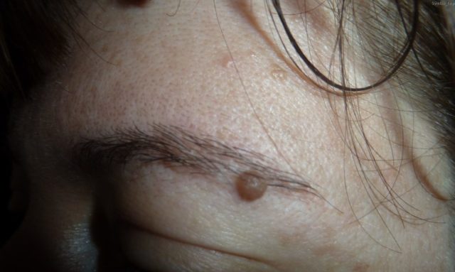 родинка на бровях