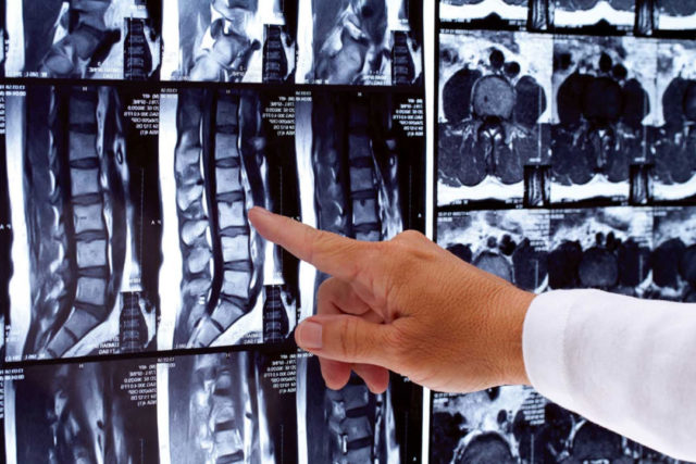 gryzha-shejnogo-otdela-pozvonochnika-priznaki