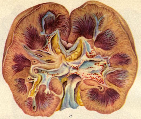 хроническая почечная недостаточность