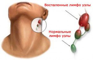 инфекционный мононуклеоз симптомы