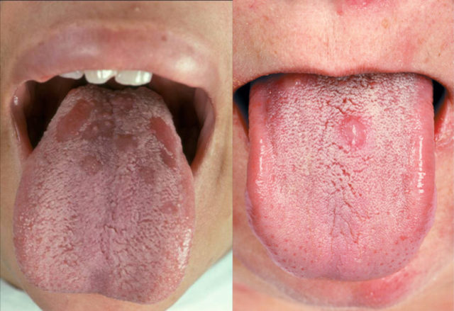 язвы на языке причины