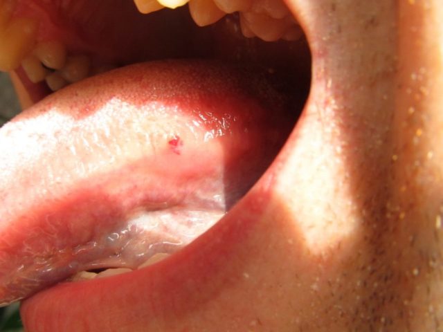 язва на языке