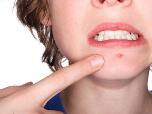 narodnye-sredstva-ot-chiriev-pod-myshkoj