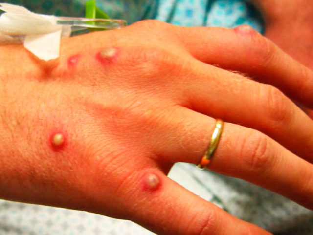 narodnye-sredstva-ot-chiriev