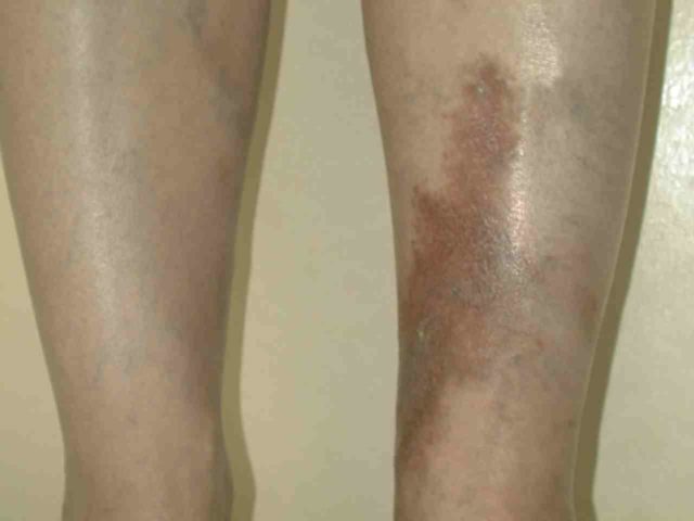 narodnye-sredstva-ot-varikoza-na-nogah