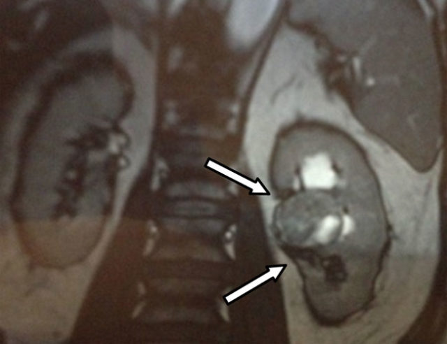 опухоль почки