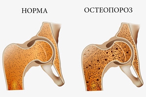 остеохондроз тазобедренного сустава
