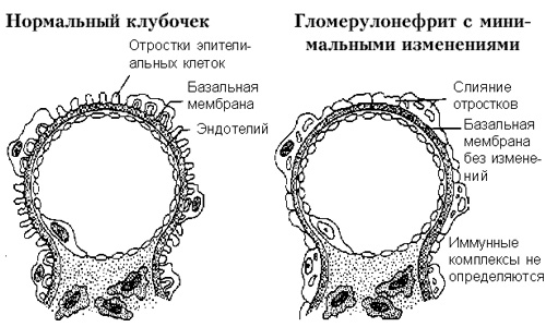 острый гломерулонефрит