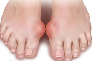 подагра на ногах