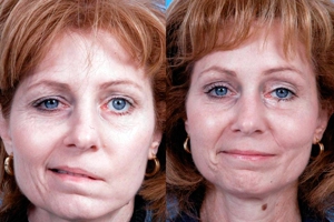 последствия инсульта