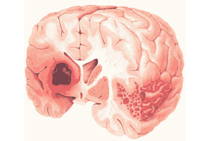 признаки инсульта
