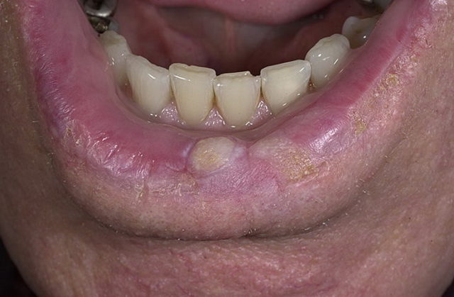 rak-guby-nachal'naja-stadija