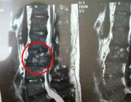 рак позвоночника симптомы и проявления