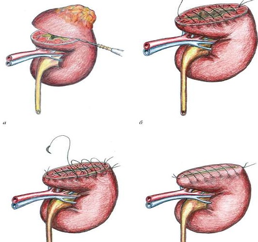 заразен ли туберкулез почек
