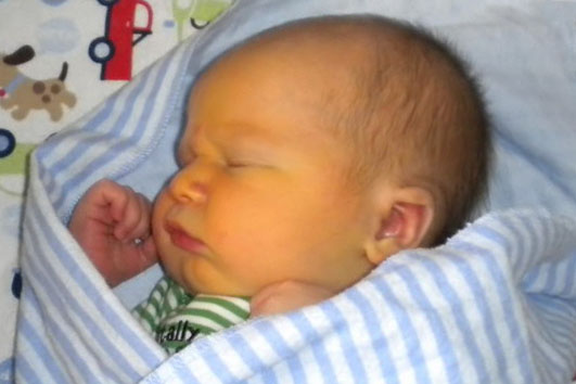 желтая кожа у младенца