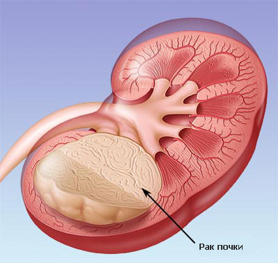 злокачественная опухоль почки