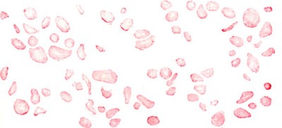 пойкилоцитоз