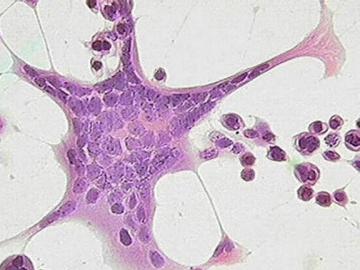 Клональный тромбоцитоз