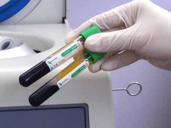 обогащенная тромбоцитами плазма