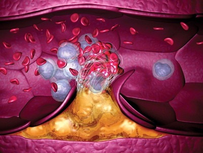 тромбофилия