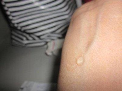 образование синяков