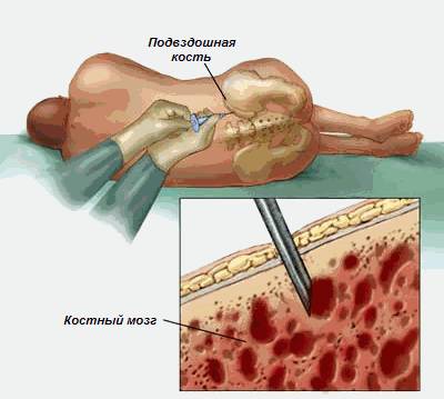 трансплантации клеток спинного мозга