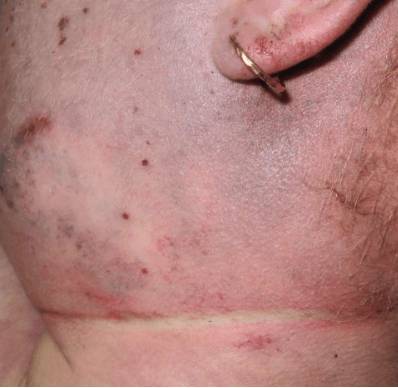 внутрикожные кровоизлияния