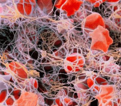 первичный тромбоцитоз