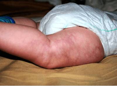 Тромбоцитопения