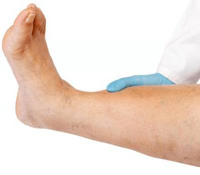 Отечность тканей