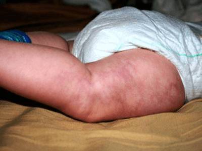 тромбоцитопения