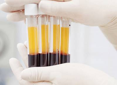 обогащенная тромбоцитами плазма