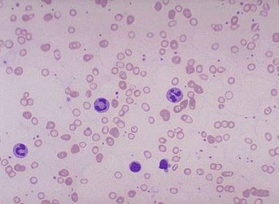 гипохромия эритроцитов