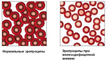 Железодефицитная анемия