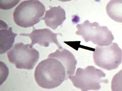 пойкилоцитоз