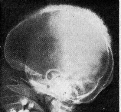 талассемия