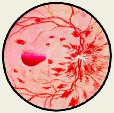 Нормохромная анемия