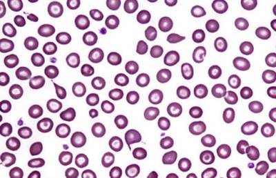 Бета-талассемия