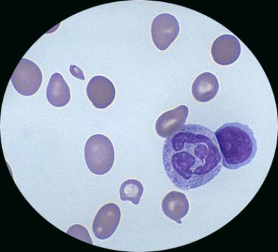 макроцитоз