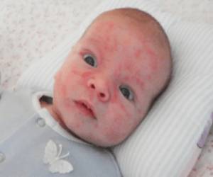 аллергическая реакция у ребенка