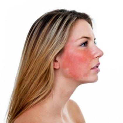 щеки красные и чешутся